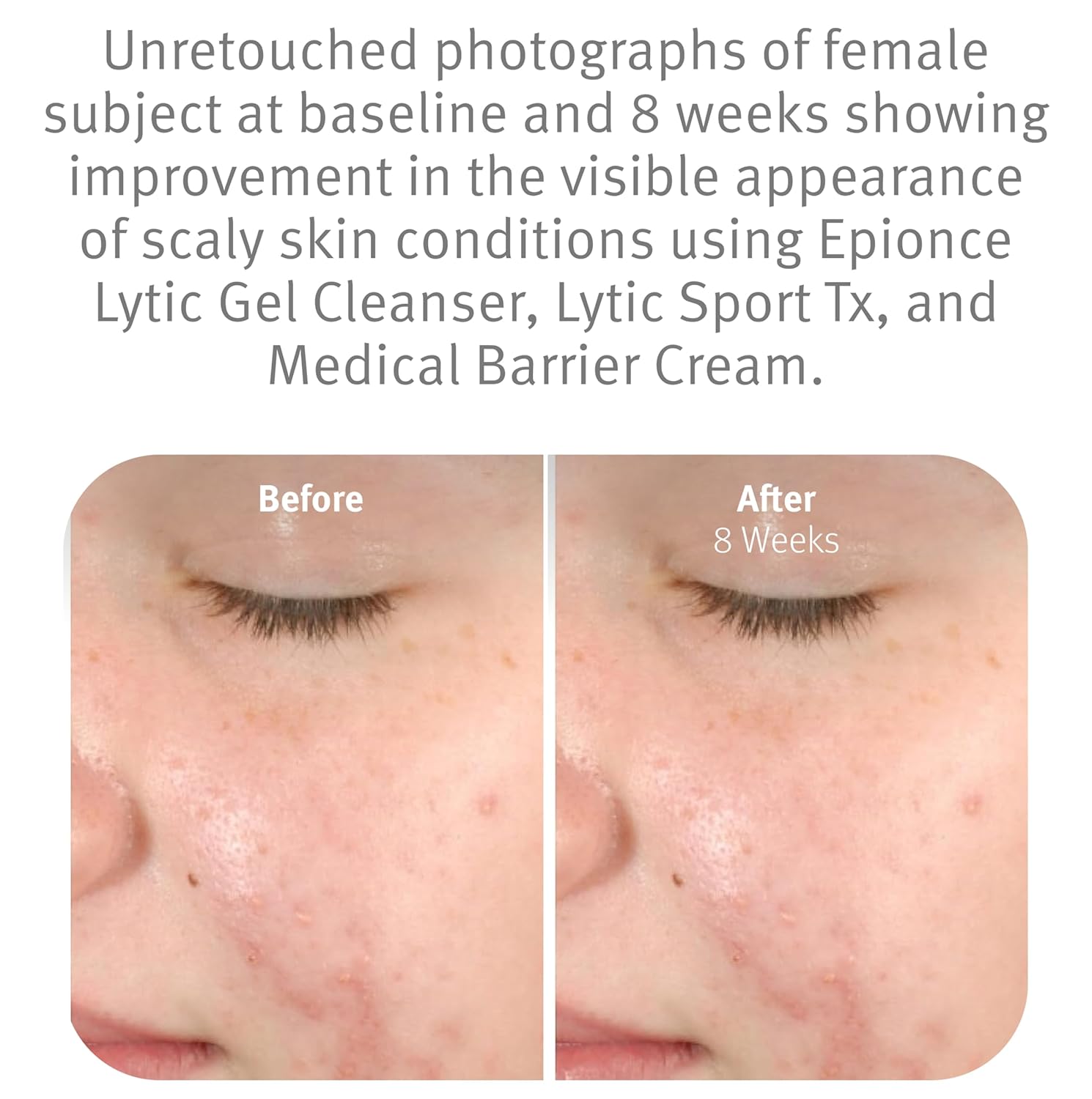 Epionce Lytic Gel Cleanser – Gentle Foaming Face Wash & Makeup Remover | For Oily, Combination & Problem Skin | Acne & Oil-Control Cleanser with Willow Bark | Dermatologist Skincare